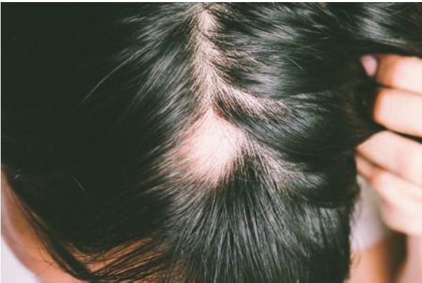 Alopecia areata: Diagnosis and Treatment
