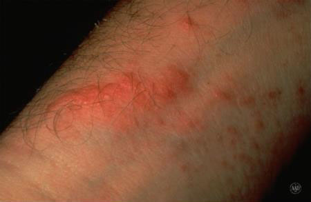 Poison ivy, Oak, and Sumac - Diagnosis and treatment